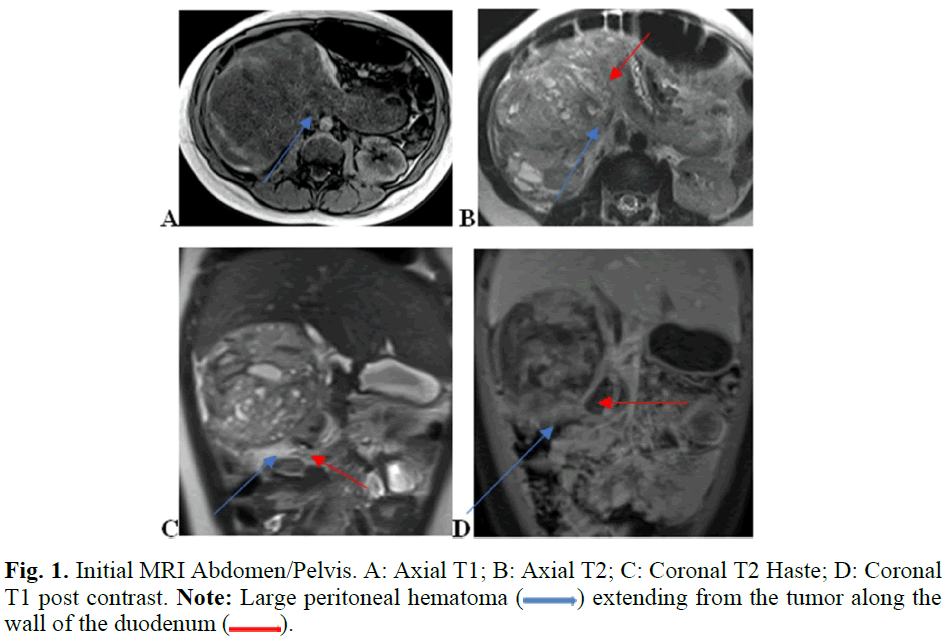 pediatricurology-hematoma