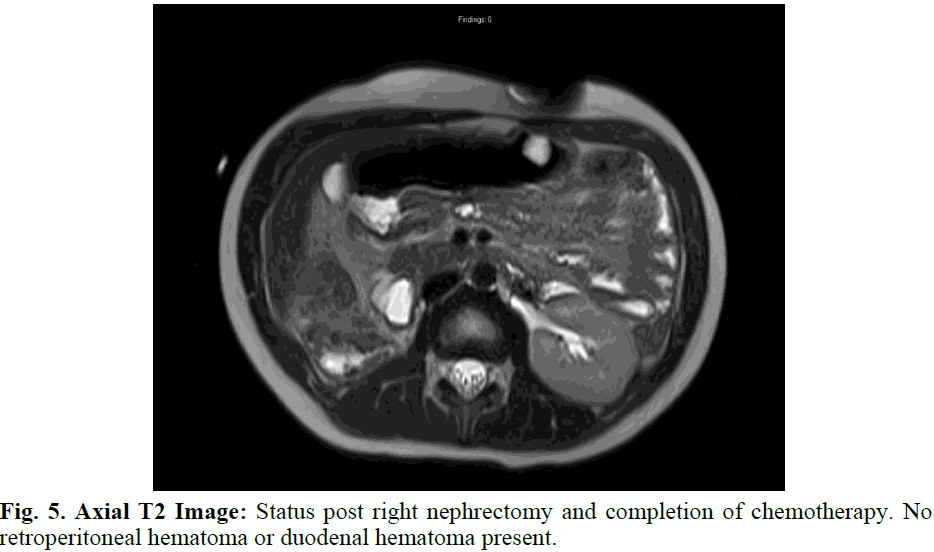 pediatricurology-nephrectomy